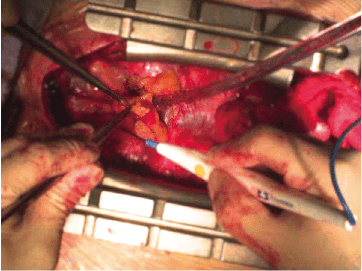 Lámpara Quirúrgica - COMEN L6 - Imagen 5